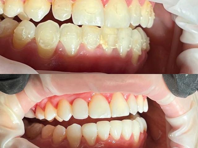 Smile dent
