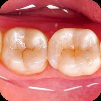 ValeoDent