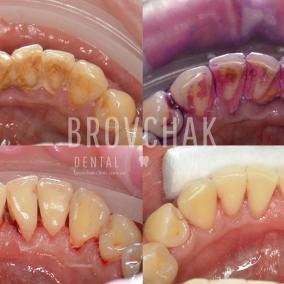 Стоматология на Голосієвській Brovchak Dental. Лікування зубов під мікроскопом Київ.. photo