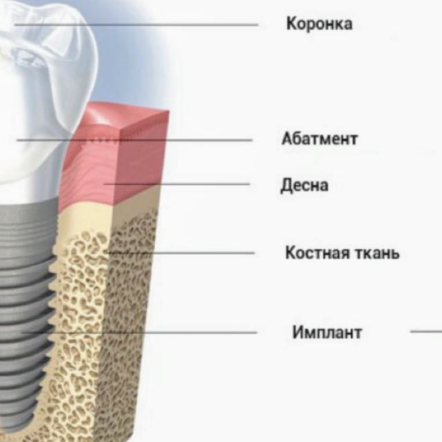 Клиника дентальной имплантации photo