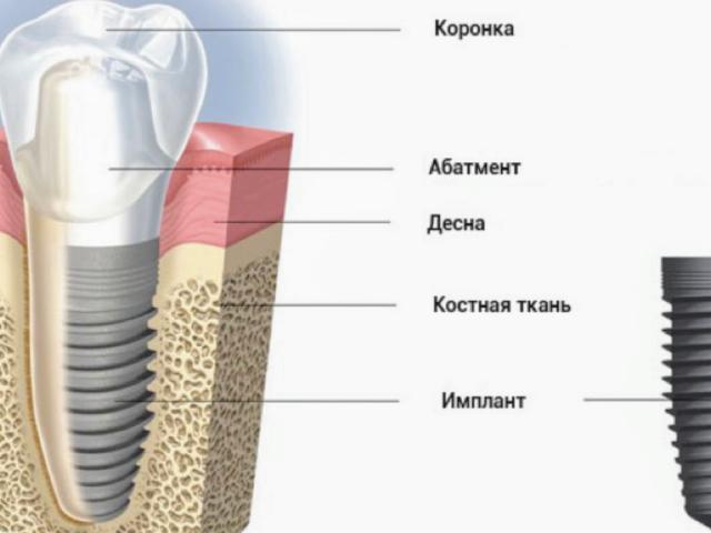 Клиника дентальной имплантации
