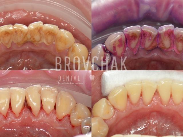 Стоматология на Голосієвській Brovchak Dental. Лікування зубов під мікроскопом Київ..