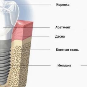 Клиника дентальной имплантации photo