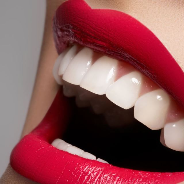 Отбеливание зубов системой Beyond в ЭстетСмайл в г. Киев