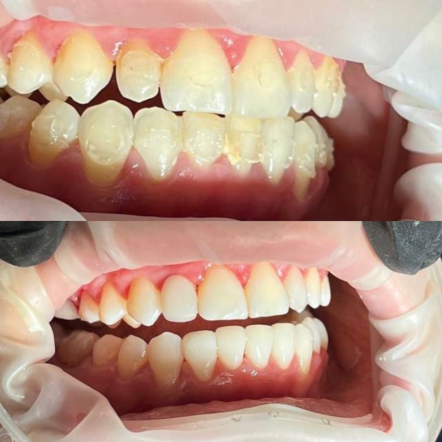Smile dent